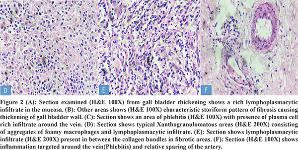 Histological Overlap in IgG4 Related and Xanthogranulomatous